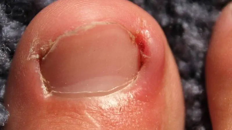 Close up of an ingrown toenail