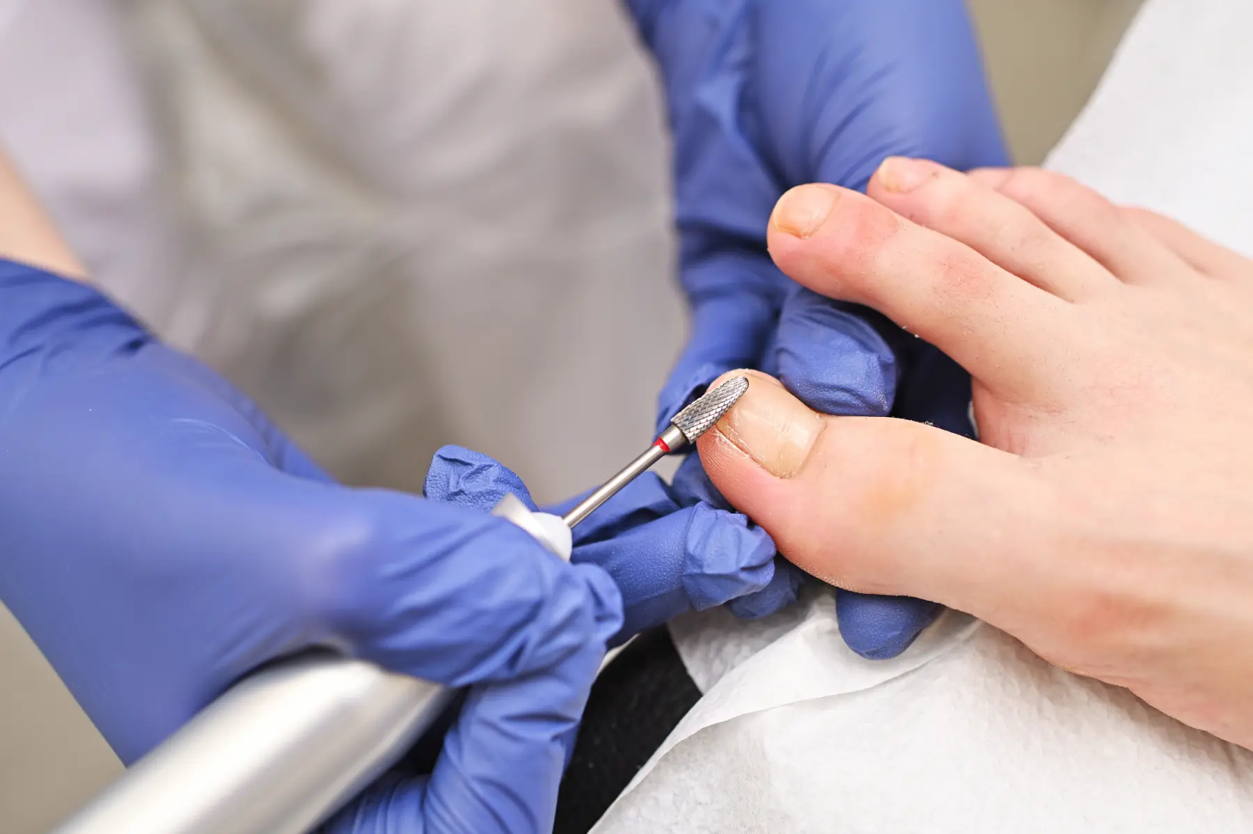 Ingrown Toenail Treatment in Lewisham