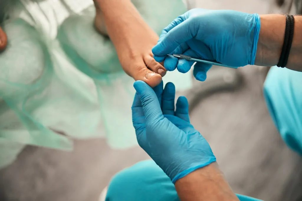 Nail Surgery