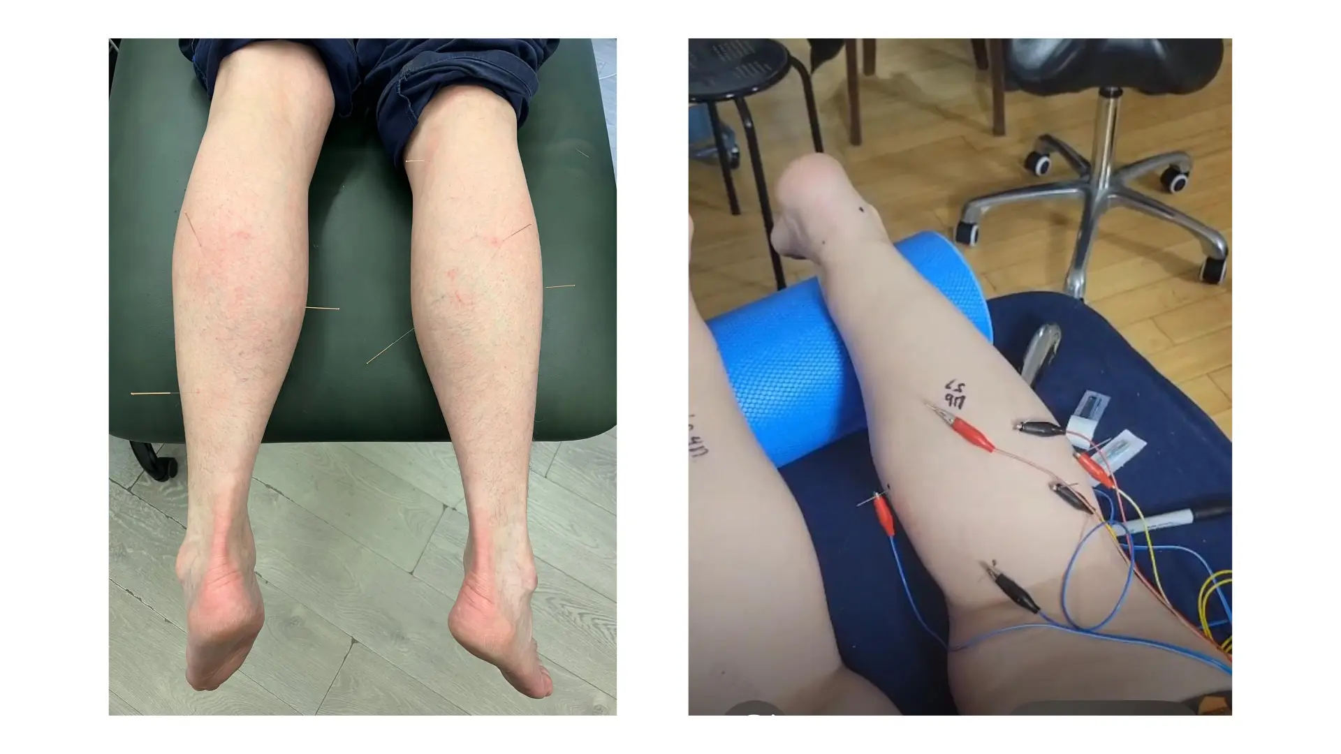 Dry Needling and Electroacupuncture in Lewisham
