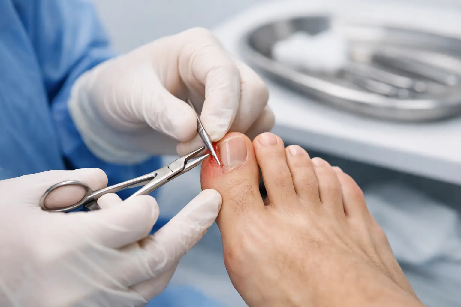 How Ingrown Toenail Surgery Works